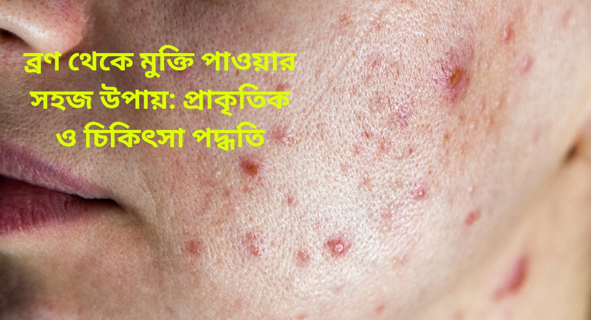 ব্রণ থেকে মুক্তি পাওয়ার সহজ উপায়: প্রাকৃতিক ও চিকিৎসা পদ্ধতি